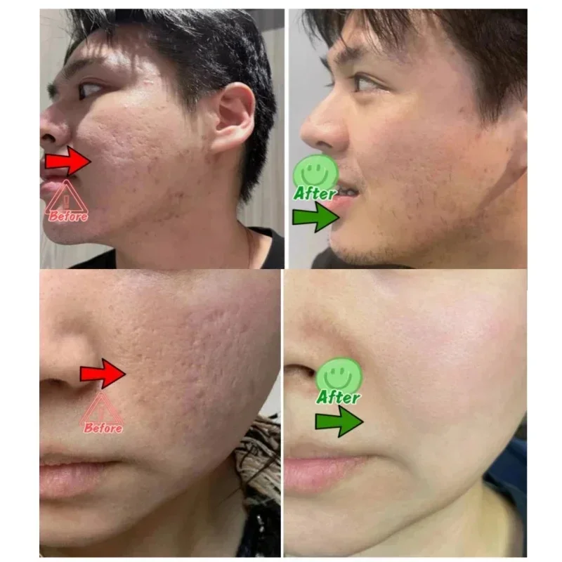 サリチル酸毛穴クリアリングクリーム毛穴を縮小黒ずみ除去にきび - Korean Skincare Routine のレビューと価格